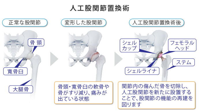 図：人口股関節置換術