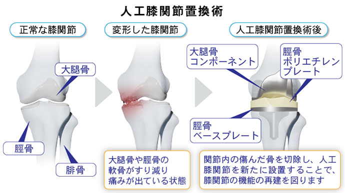 図：人口膝関節置換術